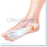 325 Plantar Fasciitis Pathology