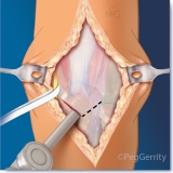 Osteotomy-400