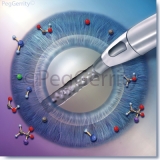293 Promotional Art for Cataract Repair