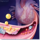 Cardiovascular-Disease-and-Plaque-092