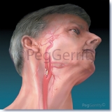 Clot-Carotid-Artery-Atherosclerosis-008