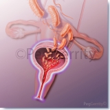Urinary-Tract-Infection-of-Bladder-Image-154