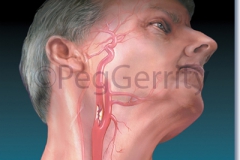 Clot-Carotid-Artery-Atherosclerosis-008