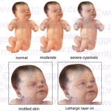 203V-Newborn-Cyanosis