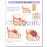 Bedsore Progression Poster 384V