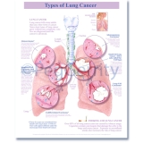 Lung Cancers Poster 493
