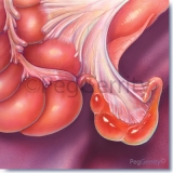 Appendicitis-Image-010