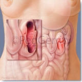 233 Intussusception