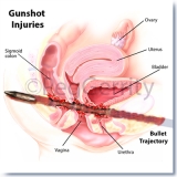 087ML-Gunshot-Wound-1