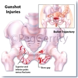 087ML-Gunshot-Wound-2