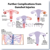 087ML-Gunshot-Wound-3