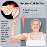 344-Rotator-Cuff-Re-Tear-A