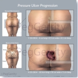 497-Pressure-Ulcer-ML-Bedsore