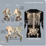 CMG-01-Car-Wreck-Fractures-B