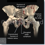 CMG-01-Car-Wreck-Fractures-C