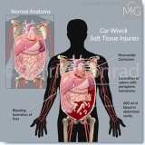 CMG 1-Car-Wreck-Soft-Tissue-Injuries-A