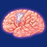 003-brain-stroke-embolism