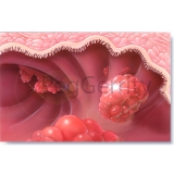 022 GI Polyps