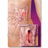 233R-Intussusception