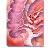 429 Crohns Disease