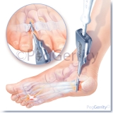 Isogard-Plantar-Fasciitis-327