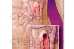 233R-Intussusception