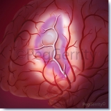 Ischemic-Stroke-w-Penumbra-Image-409