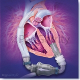 LVAD-Heartmate-II-Pump-image-353