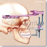 Maxillary-Distraction-Surgery-Image-002