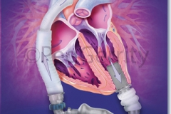 LVAD-Heartmate-II-Pump-image-353