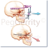 002V-Maxillary-Distraction