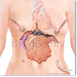 Omentum Flap over LVAD Surgery (323)