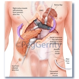 Rectal Flap over LVAD Surgery (323)