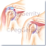 356-Rotator-cuff-tear-and-repair