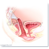 438A Repair of Vaginal Vault