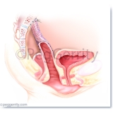 438B Vaginal Vault Repair w Mesh