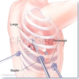441-Thorascopic-Surgery
