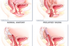437-and-438-Vag-Vault-Prolapse-Repair