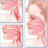 223 Croup and Epiglottitis