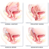 437, 438 Vaginal Vault Prolapse Repair